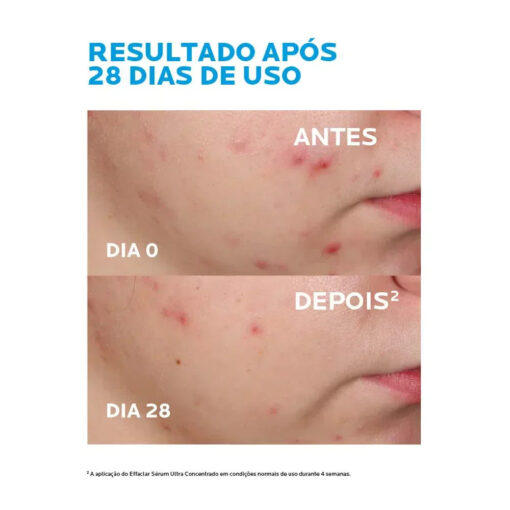 La Roche-Posay Effaclar Ultra Concentrado - Sérum Antiacne 30ml - Image 7